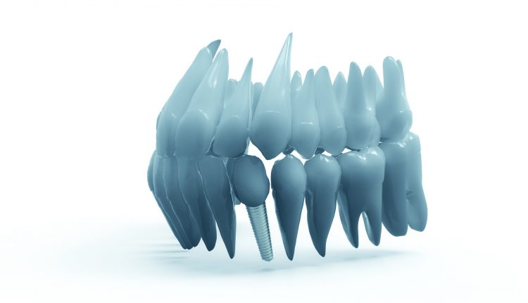 implant-dentar-in-Bucuresti