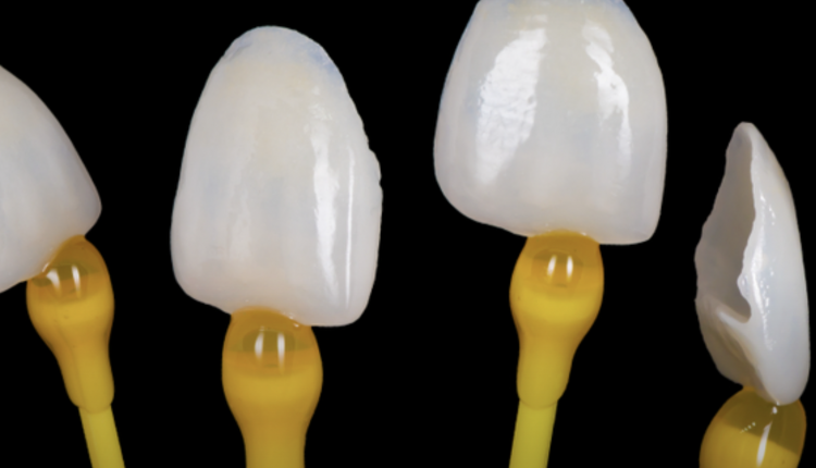 Fațete dentare în București